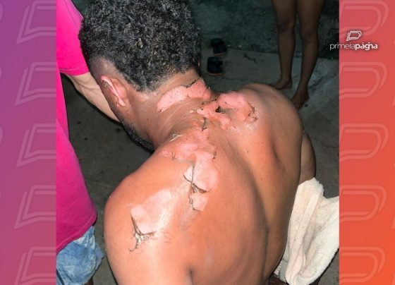 Homem teve o corpo queimado durante discussão com esposa. - Foto: Reprodução