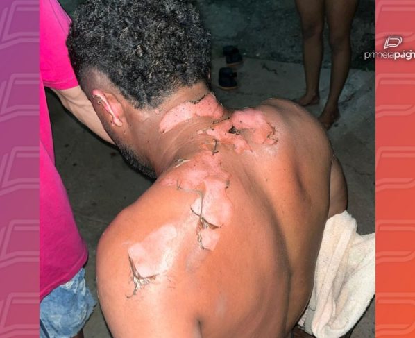 Homem teve o corpo queimado durante discussão com esposa. - Foto: Reprodução