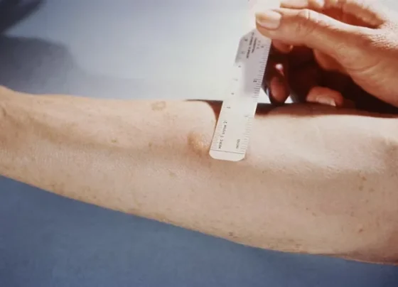 Teste de tuberculose