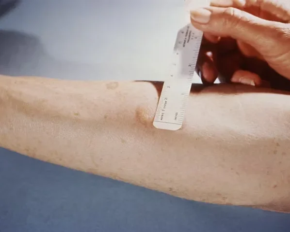 Teste de tuberculose